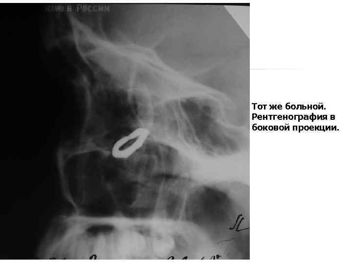 Тот же больной. Рентгенография в боковой проекции. 