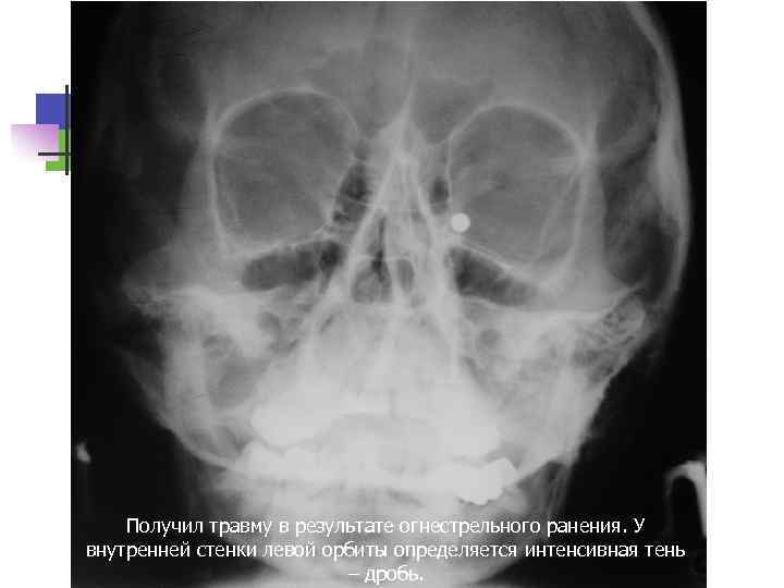 Получил травму в результате огнестрельного ранения. У внутренней стенки левой орбиты определяется интенсивная тень
