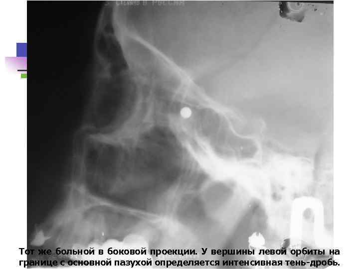 Тот же больной в боковой проекции. У вершины левой орбиты на границе с основной