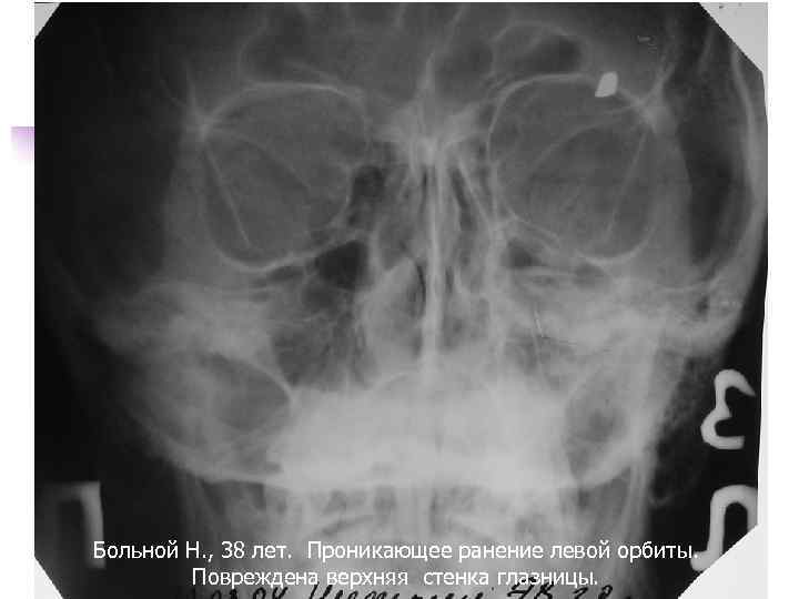 Больной Н. , 38 лет. Проникающее ранение левой орбиты. Повреждена верхняя стенка глазницы. 