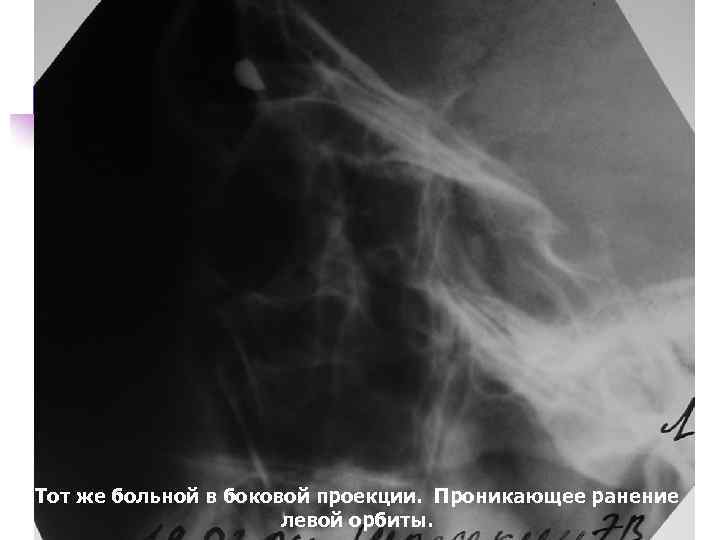 Тот же больной в боковой проекции. Проникающее ранение левой орбиты. 