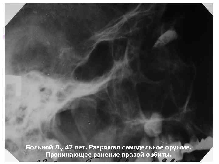 Больной Л. , 42 лет. Разряжал самодельное оружие. Проникающее ранение правой орбиты. 