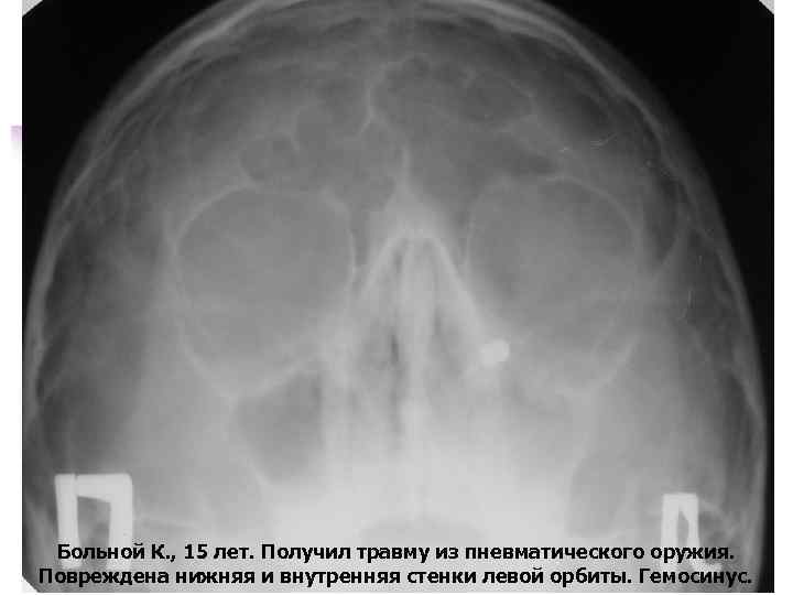 Больной К. , 15 лет. Получил травму из пневматического оружия. Повреждена нижняя и внутренняя