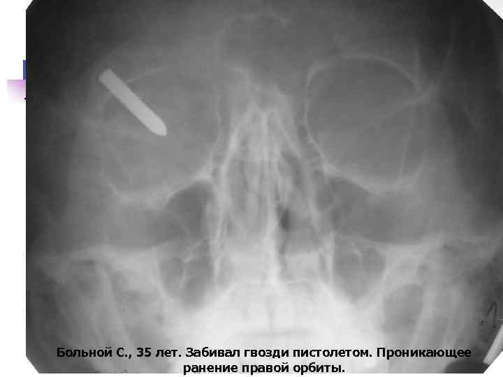 Больной С. , 35 лет. Забивал гвозди пистолетом. Проникающее ранение правой орбиты. 