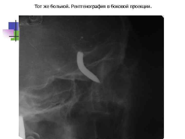 Тот же больной. Рентгенография в боковой проекции. 