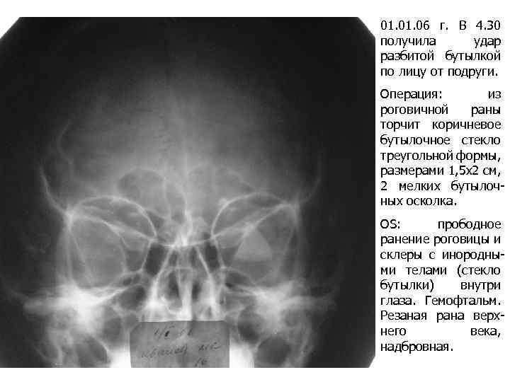 01. 06 г. В 4. 30 получила удар разбитой бутылкой по лицу от подруги.