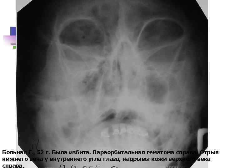 Больная Г. , 52 г. Была избита. Параорбитальная гематома справа. Отрыв нижнего вена у
