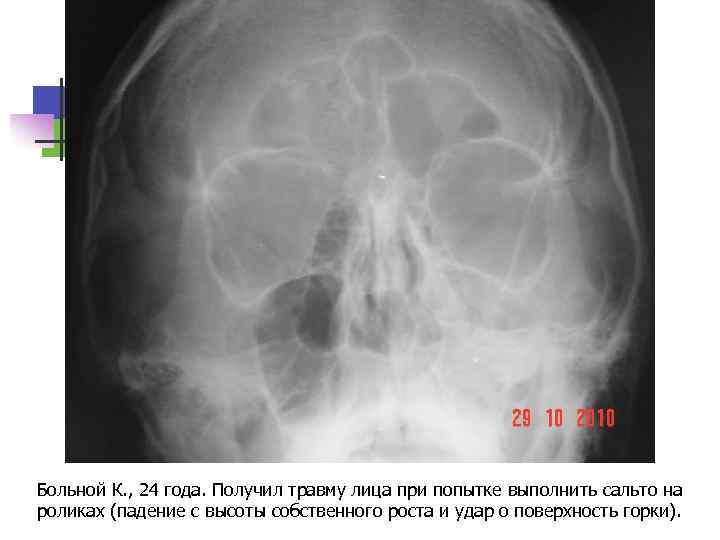 Больной К. , 24 года. Получил травму лица при попытке выполнить сальто на роликах