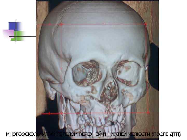 МНОГООСКОЛЬЧАТЫЙ ПЕРЕЛОМ ВЕРЕХНЕЙ И НИЖНЕЙ ЧЕЛЮСТИ (ПОСЛЕ ДТП) 