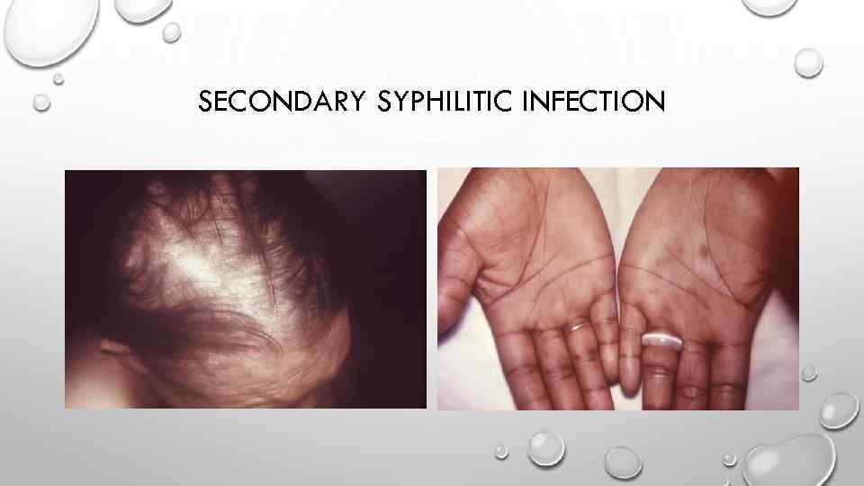 SECONDARY SYPHILITIC INFECTION 