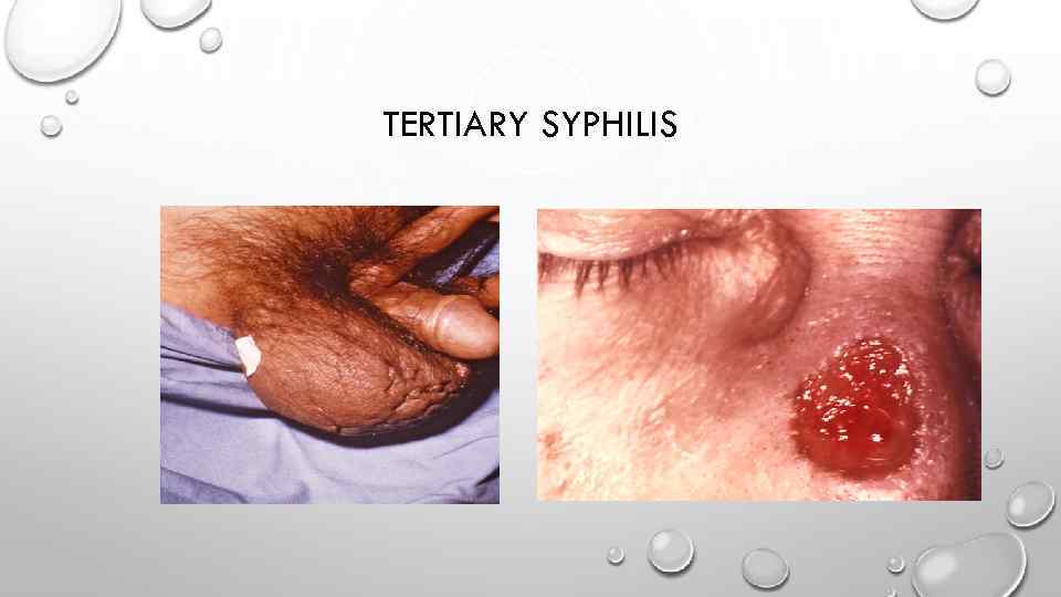 TERTIARY SYPHILIS 