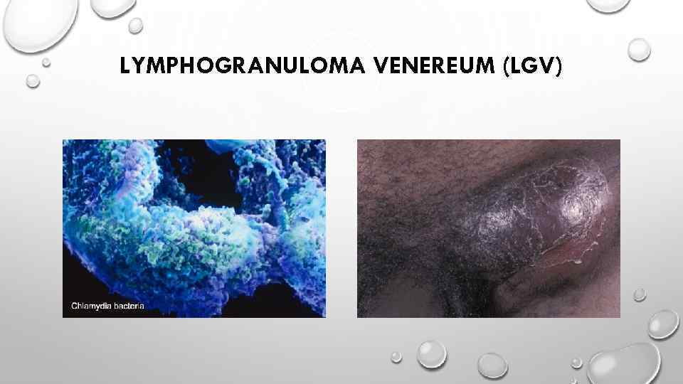 LYMPHOGRANULOMA VENEREUM (LGV) 