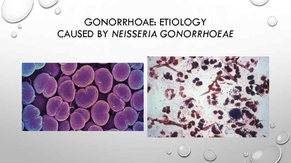 GONORRHOAE: ETIOLOGY CAUSED BY NEISSERIA GONORRHOEAE 