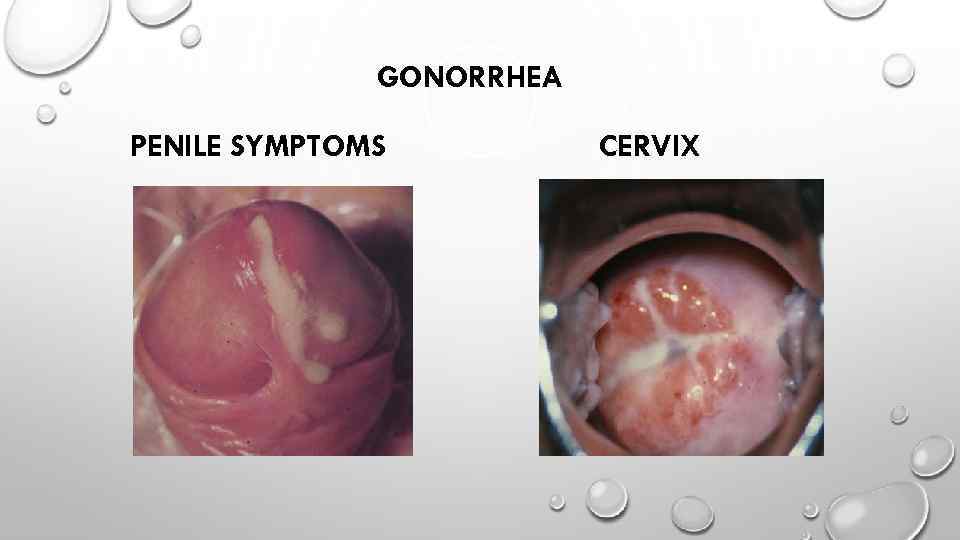 GONORRHEA PENILE SYMPTOMS CERVIX 