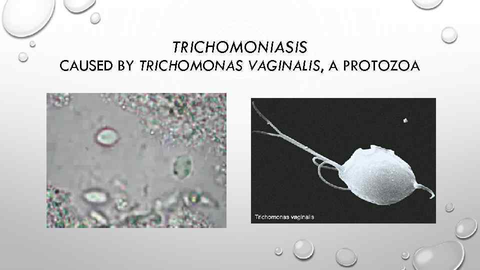 TRICHOMONIASIS CAUSED BY TRICHOMONAS VAGINALIS, A PROTOZOA 