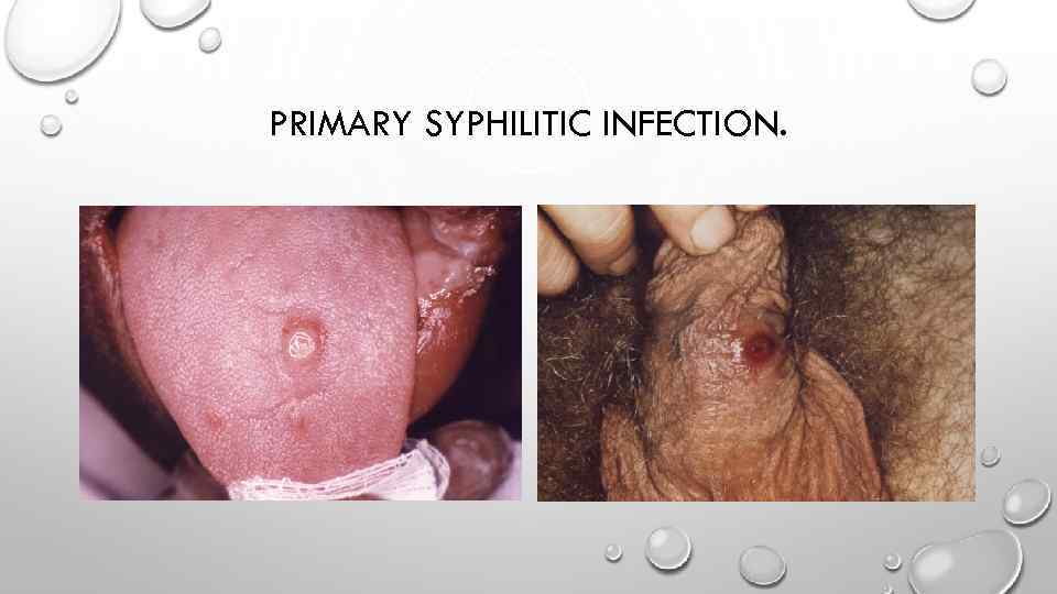 PRIMARY SYPHILITIC INFECTION. 