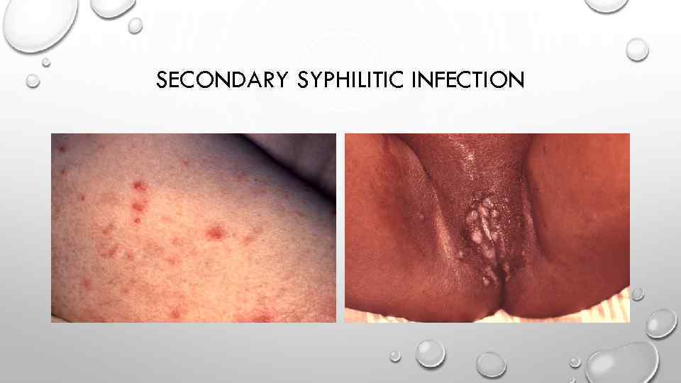 SECONDARY SYPHILITIC INFECTION 