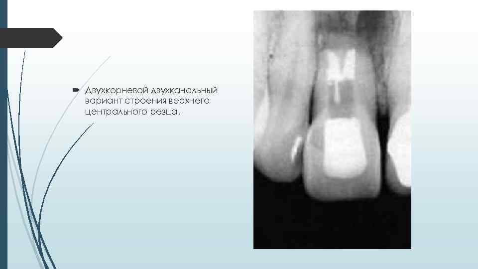  Двухкорневой двухканальный вариант строения верхнего центрального резца. 