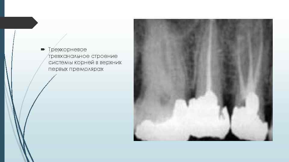  Трехкорневое трехканальное строение системы корней в верхних первых премолярах 