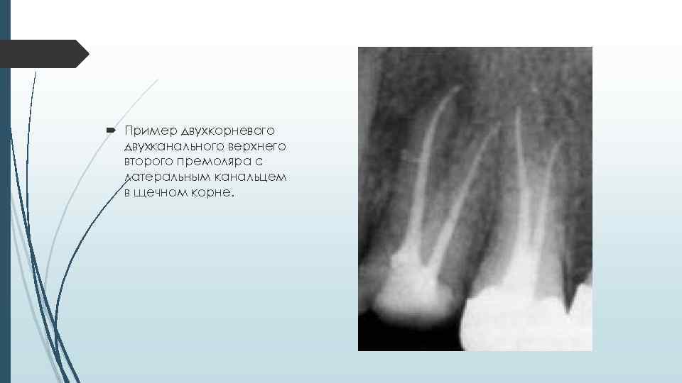  Пример двухкорневого двухканального верхнего второго премоляра с латеральным канальцем в щечном корне. 
