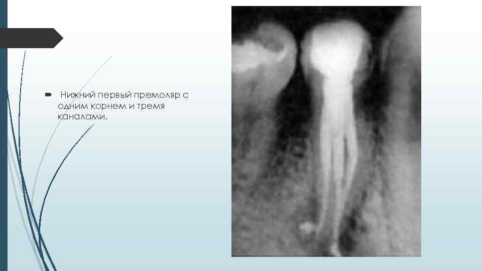  Нижний первый премоляр с одним корнем и тремя каналами. 