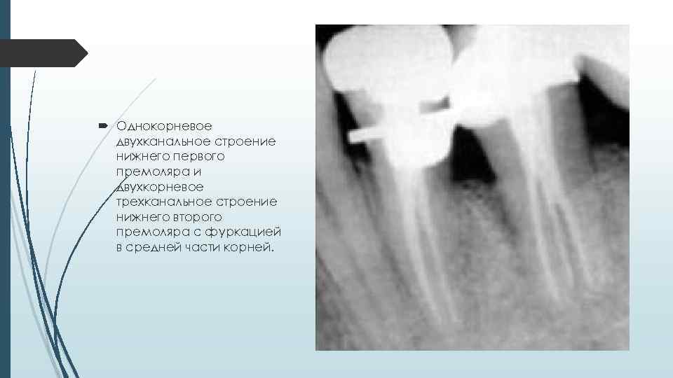  Однокорневое двухканальное строение нижнего первого премоляра и двухкорневое трехканальное строение нижнего второго премоляра