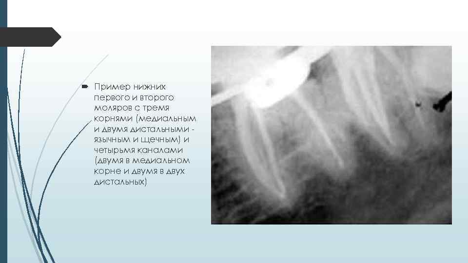  Пример нижних первого и второго моляров с тремя корнями (медиальным и двумя дистальными