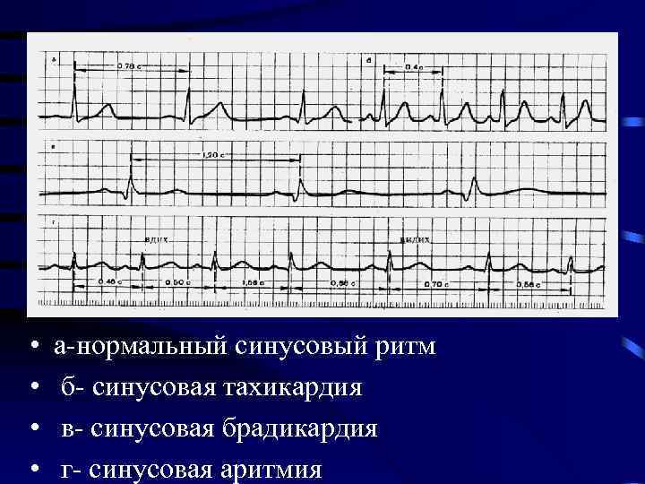  • • а-нормальный синусовый ритм б- синусовая тахикардия в- синусовая брадикардия г- синусовая