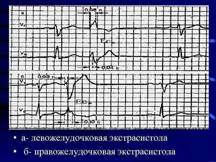  • а- левожелудочковая экстрасистола • б- правожелудочковая экстрасистола 