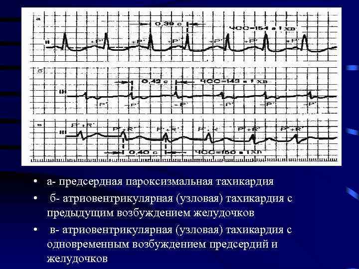  • а- предсердная пароксизмальная тахикардия • б- атриовентрикулярная (узловая) тахикардия с предыдущим возбуждением