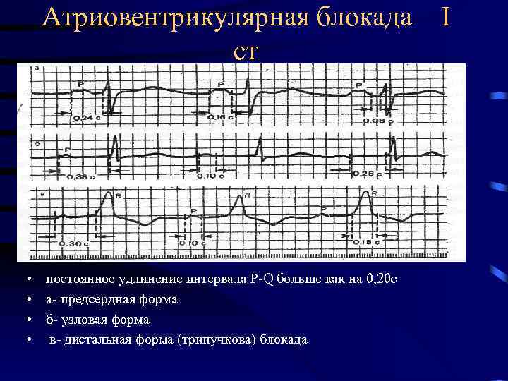 Атриовентрикулярная блокада ст • постоянное удлинение интервала P-Q больше как на 0, 20 с