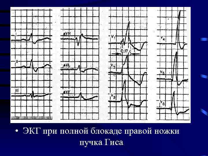  • ЭКГ при полной блокаде правой ножки пучка Гиса 