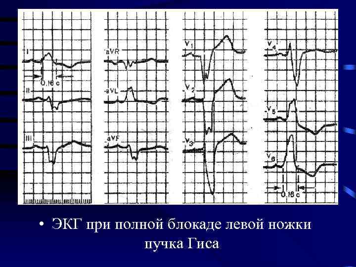  • ЭКГ при полной блокаде левой ножки пучка Гиса 