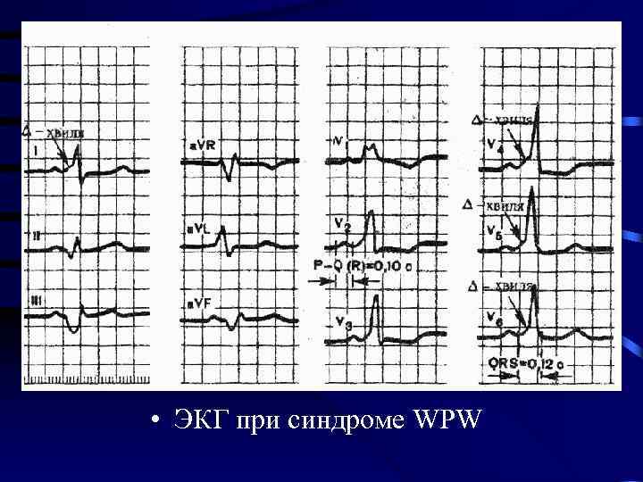  • ЭКГ при синдроме WPW 