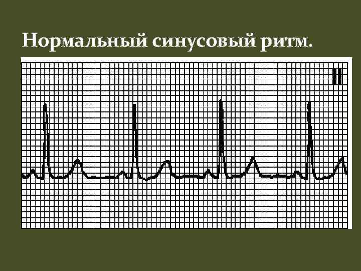 Нормальный синусовый ритм. 