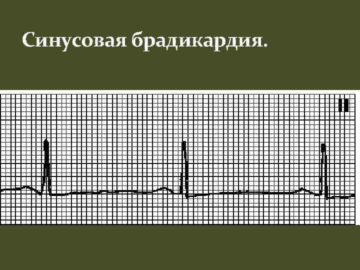 Синусовая брадикардия. 