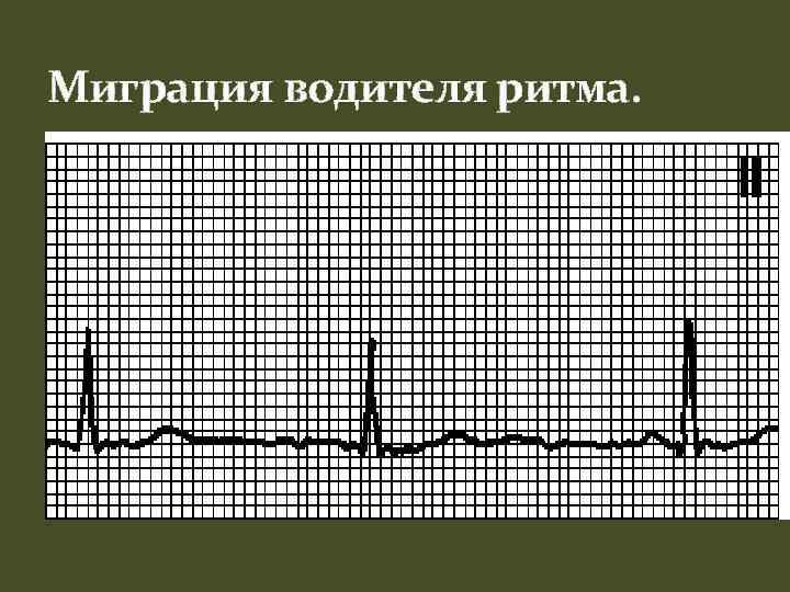 Миграция водителя ритма. 