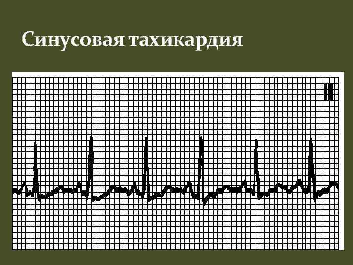Синусовая тахикардия 