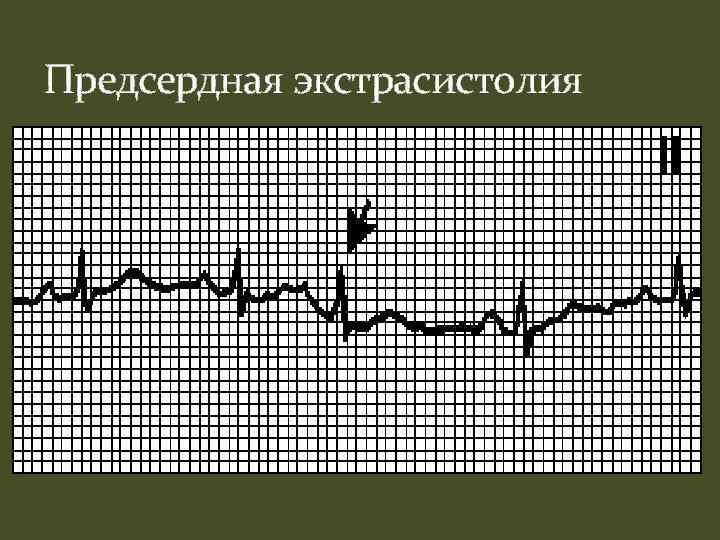 Предсердная экстрасистолия 