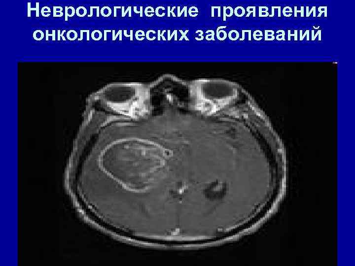 Неврологические проявления онкологических заболеваний 