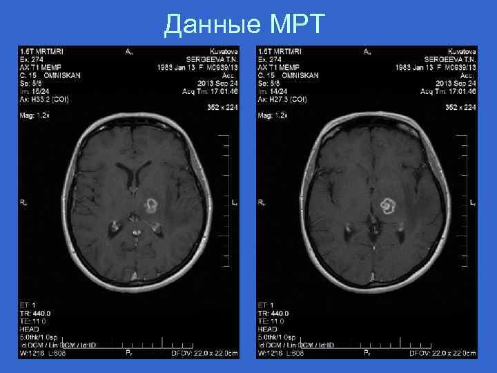 Данные МРТ 