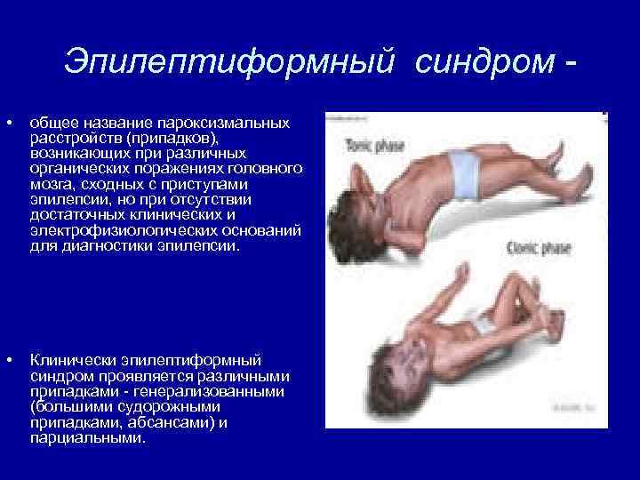 Эпилептиформный синдром • общее название пароксизмальных расстройств (припадков), возникающих при различных органических поражениях головного