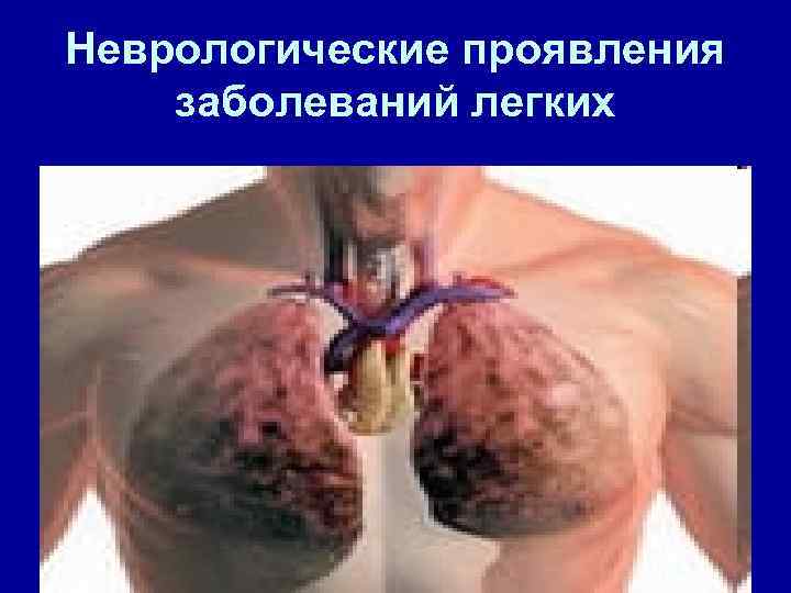 Неврологические проявления заболеваний легких 