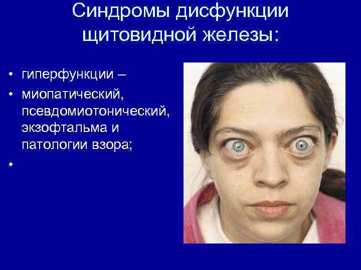 Синдромы дисфункции щитовидной железы: • гиперфункции – • миопатический, псевдомиотонический, экзофтальма и патологии взора;