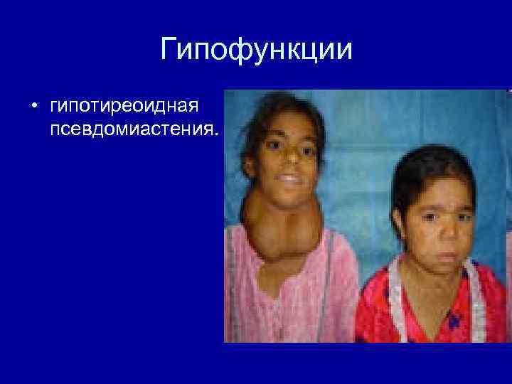 Гипофункции • гипотиреоидная псевдомиастения. 