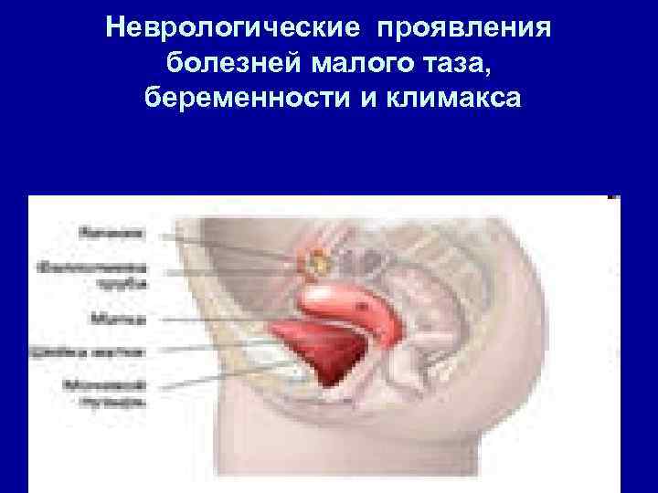 Неврологические проявления болезней малого таза, беременности и климакса 