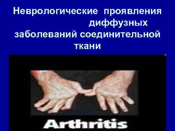 Неврологические проявления диффузных заболеваний соединительной ткани 