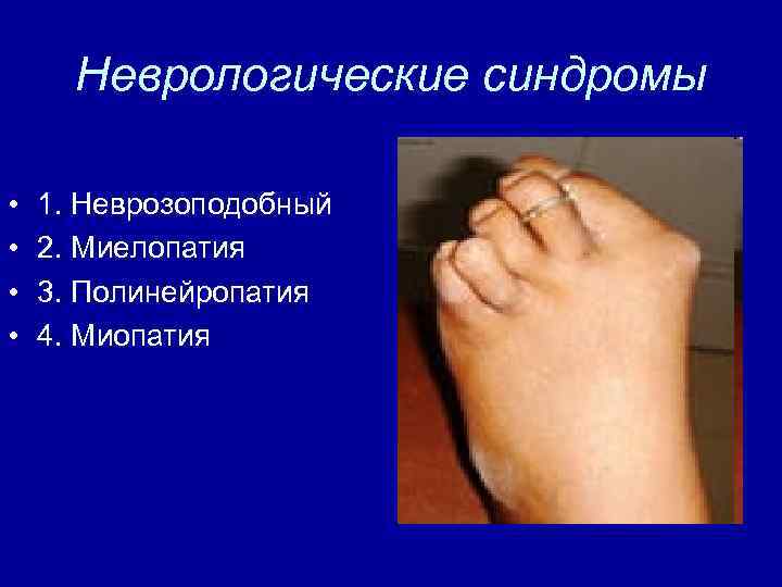 Неврологические синдромы • • 1. Неврозоподобный 2. Миелопатия 3. Полинейропатия 4. Миопатия 