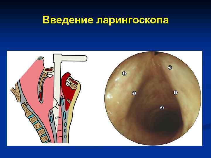 Введение ларингоскопа 