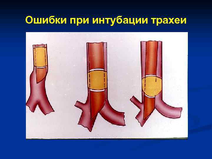 Ошибки при интубации трахеи 